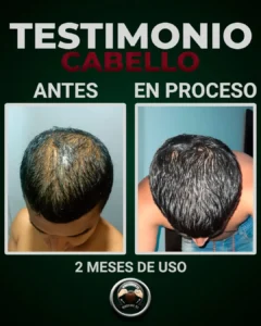 caida del cabello por alopecia