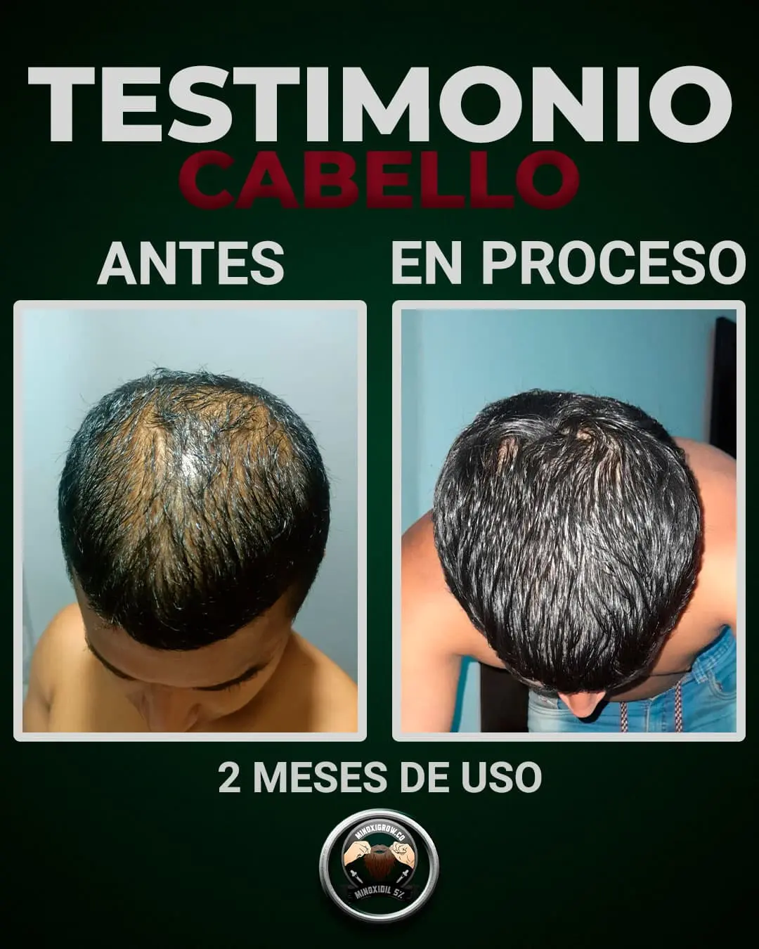 caida del cabello por alopecia