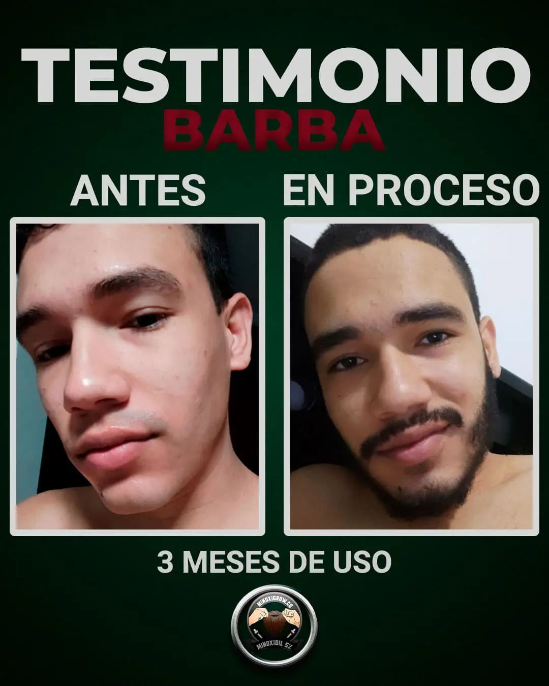 joven muestra sus resultados en barba