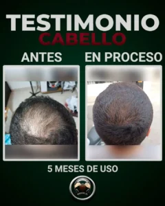 alopecia de 4 meses