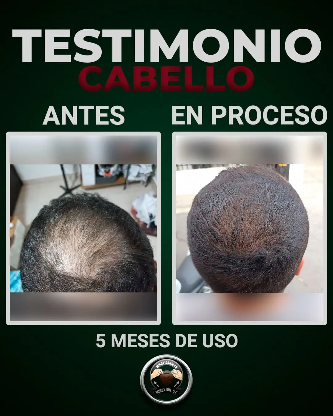 alopecia de 4 meses