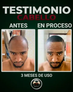 alopecia en hombre joven