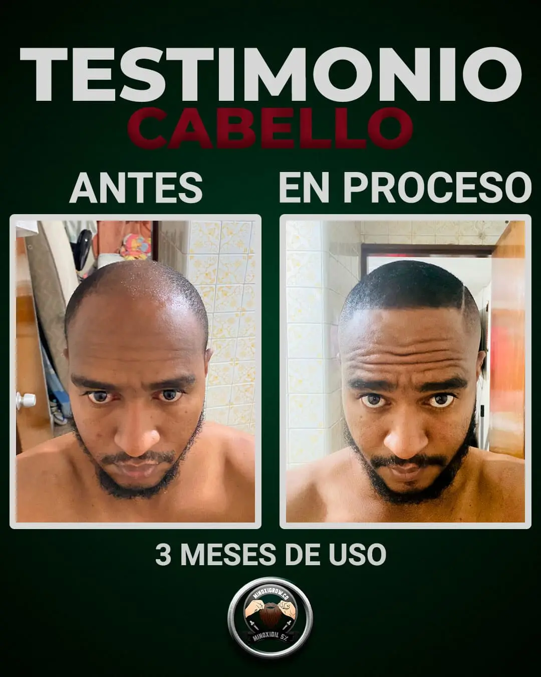 alopecia en hombre joven