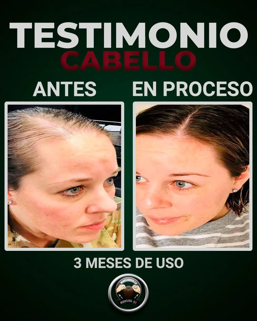 mujer con perdida de cabello