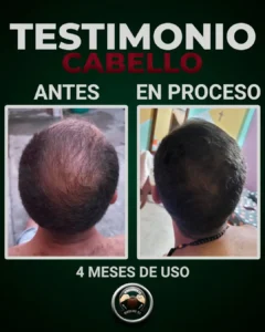 hombre con alopecia
