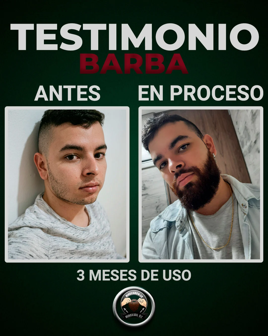 Minoxigrow hombre mostrando sus resultados en barba con el tonico